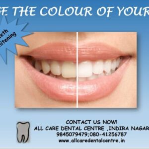 teeth whitening in bangalorelore