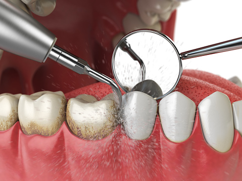 Visit a Reputed Dental Clinic to get the right Teeth Polishing Services