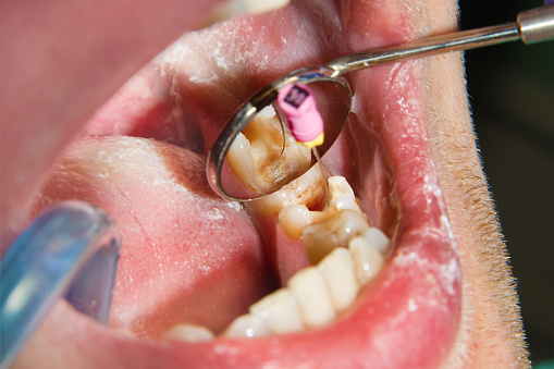 What is Endodontics in Dentistry And What Do They Do?